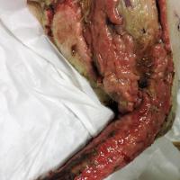  MLS® nel trattamento di una lesione necrotica da morso di ragno